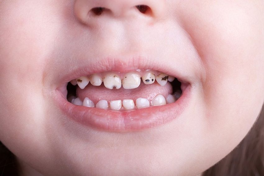 Черные зубы у детей