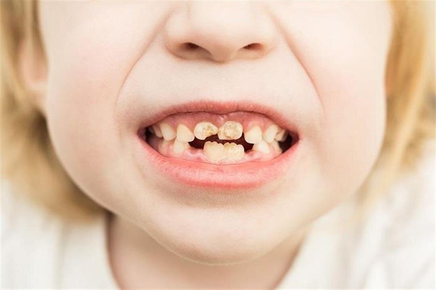 Детские зубы с кариесом