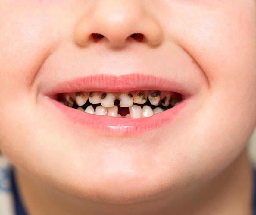 Зубы кариес у детей
