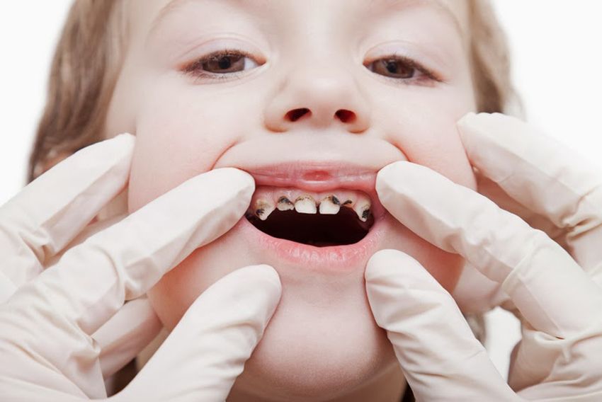 Детские зубы кариес