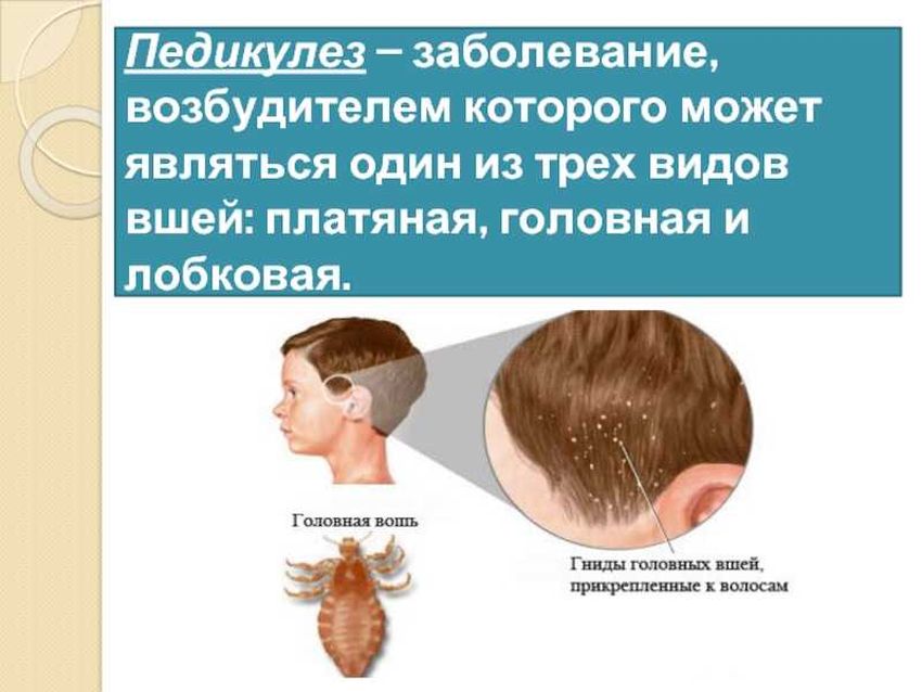 Педикулёз Симптомы головного педикулеза