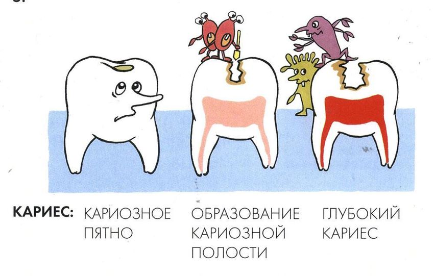 Кариес зубов