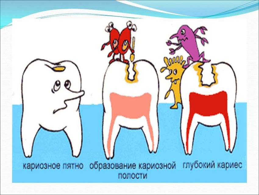 Зубы кариес