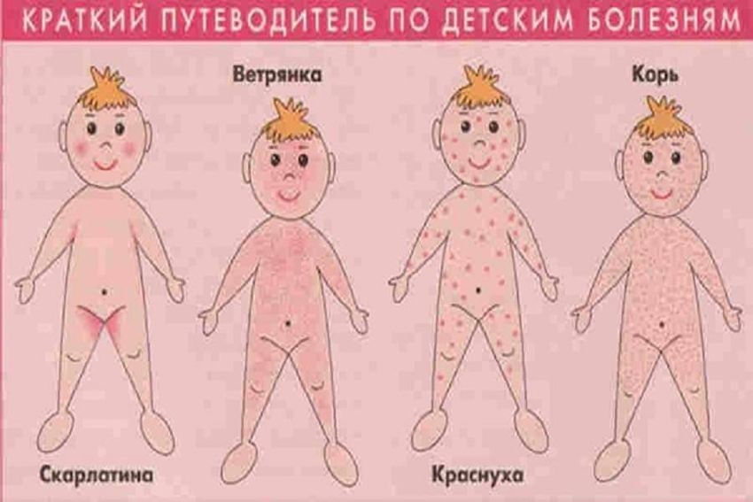Сыпь корь краснуха ветрянка Высыпания корь краснуха ветрянка