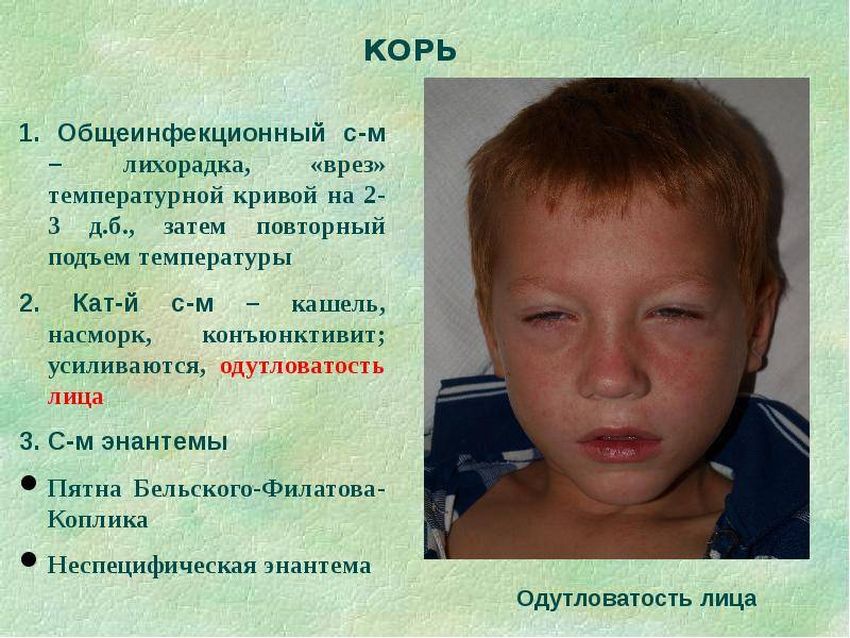 Корь Краснуха энантема