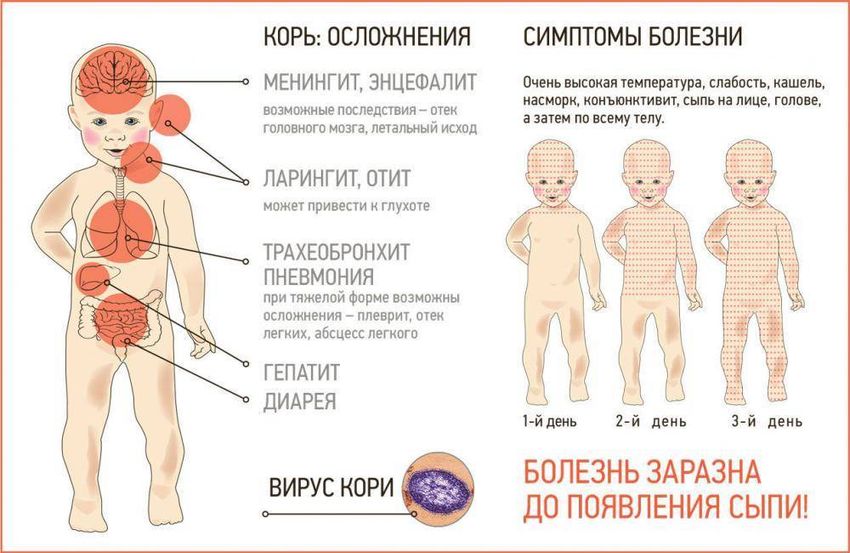 Корь симптомы Корь