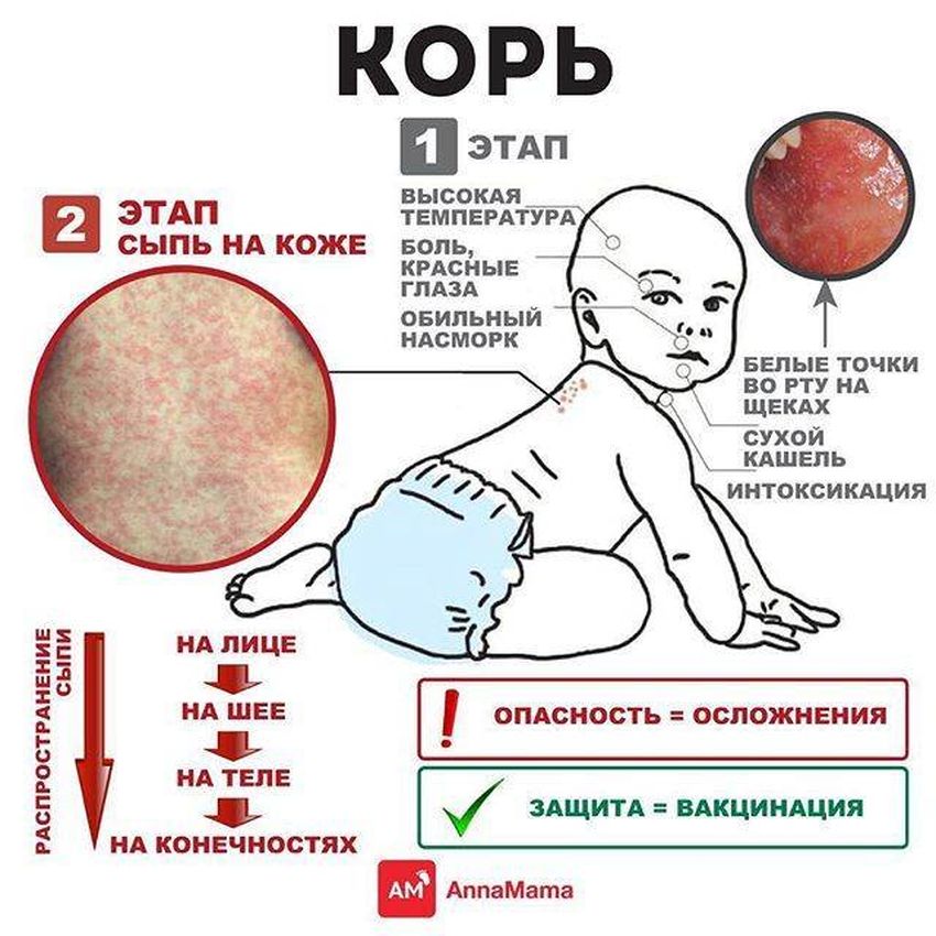 Корь Корь симптомы