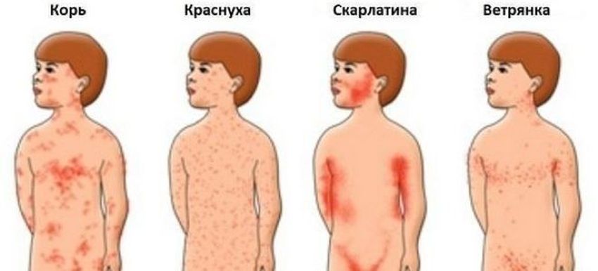 Корь краснуха паротит Краснуха