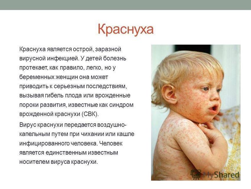 Болезнь краснуха Болезнь коревая краснуха