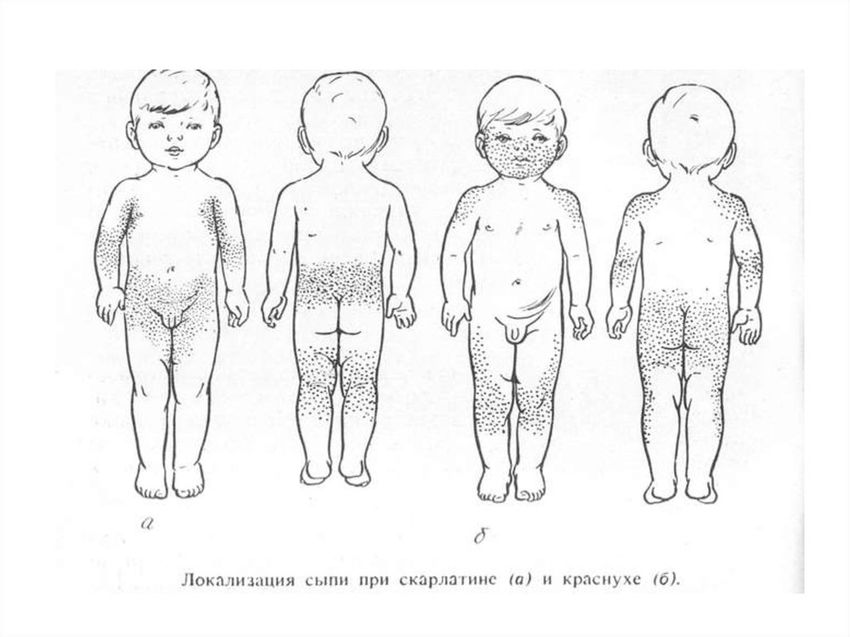Сыпь корь Сыпь при краснухе