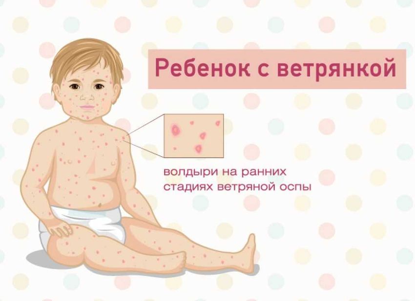 Ветрянка ветряная оспа