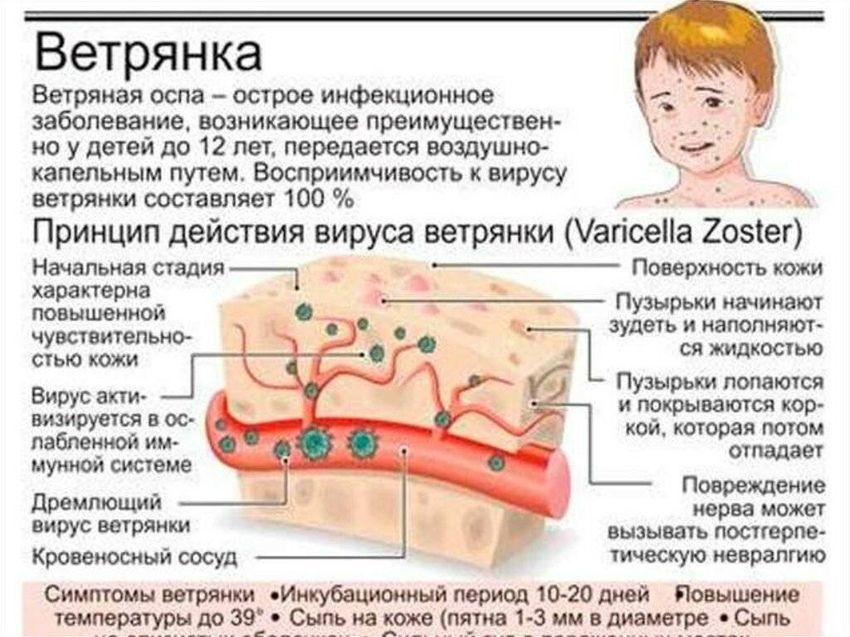 Ветрянка ветряная оспа