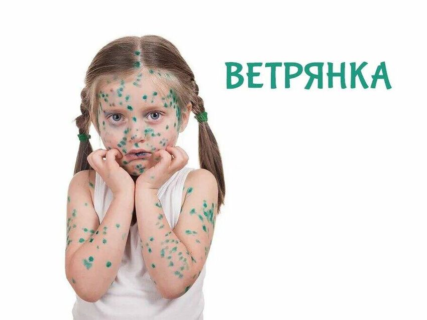 Ветрянка ветряная оспа