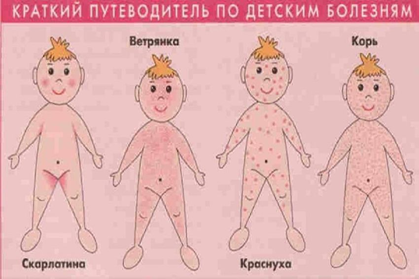 Сыпь корь краснуха ветрянка