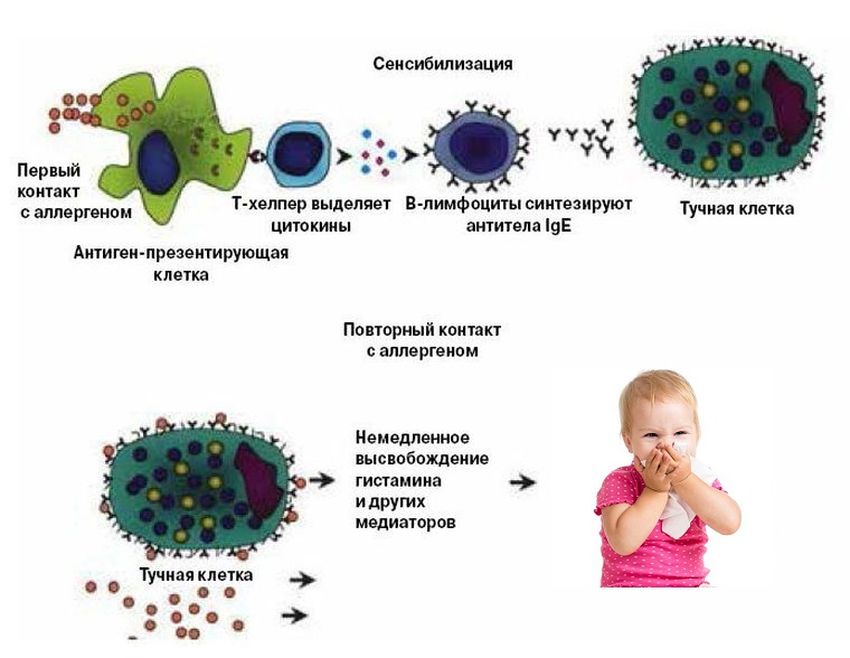 Аллергическая реакция немедленного типа Механизм развития аллергии