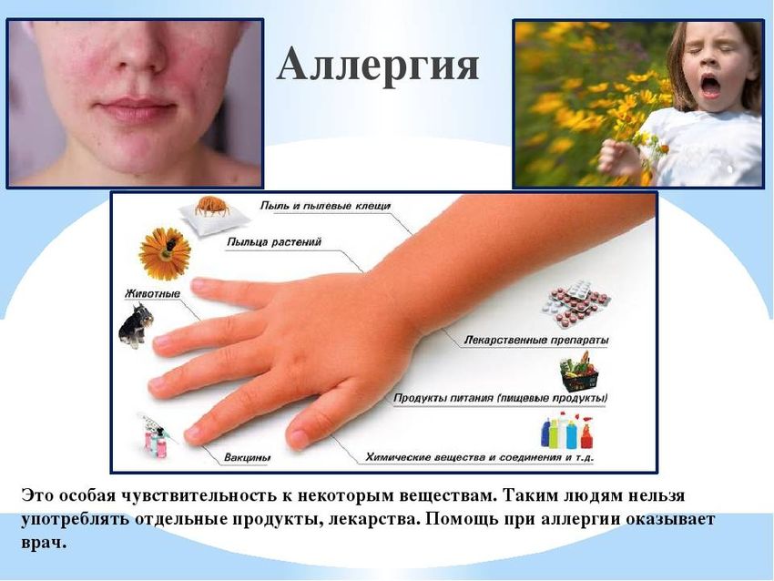 Аллергии Аллергия виды