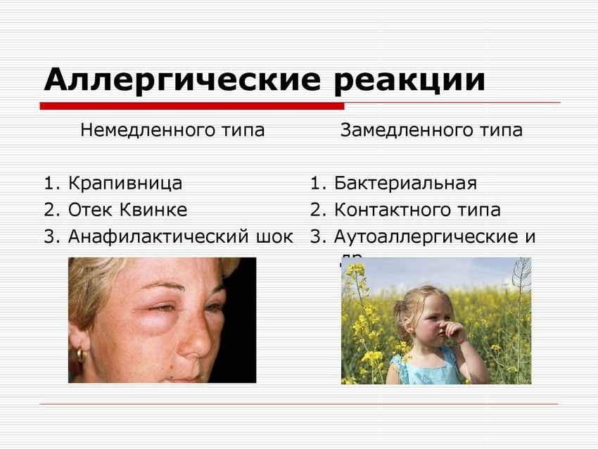Аллергическая реакция Аллергические реакции типы